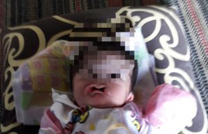 Nur Hakiki, Lahir ke Dunia Tanpa Hidung dan Anus