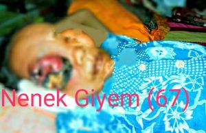 Sang Nenek 5 Tahun Melawan Tumor Ganas Dimatanya